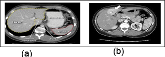 Figure 2 : (a) Normal intestinal CT scans (b) Liver stone image[1] 